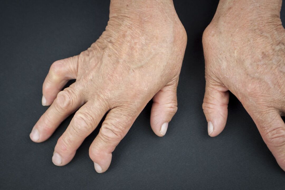 gout in your hands