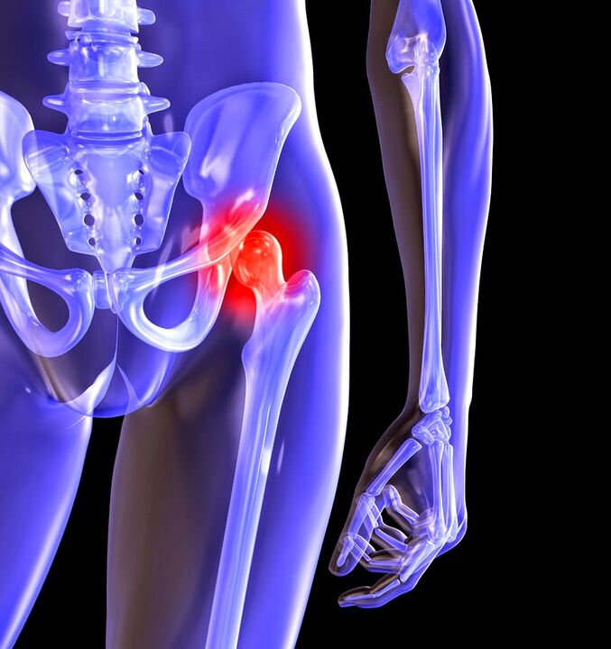 Deformation of hip joint