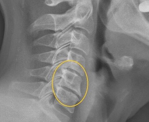 X -Ray osteocondrosis of the cervical waist
