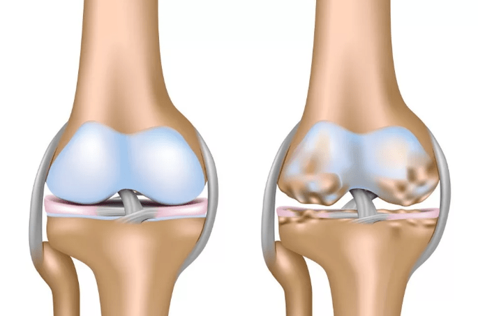 Deformation of knee joint